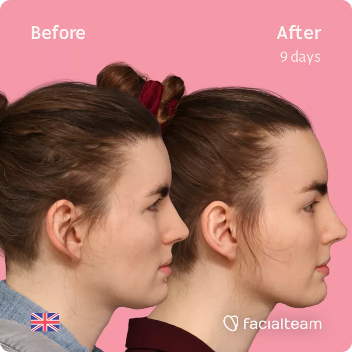 Square side image of FFS patient Eve showing the results before and after facial feminization surgery with Facialteam consisting of forehead feminization.