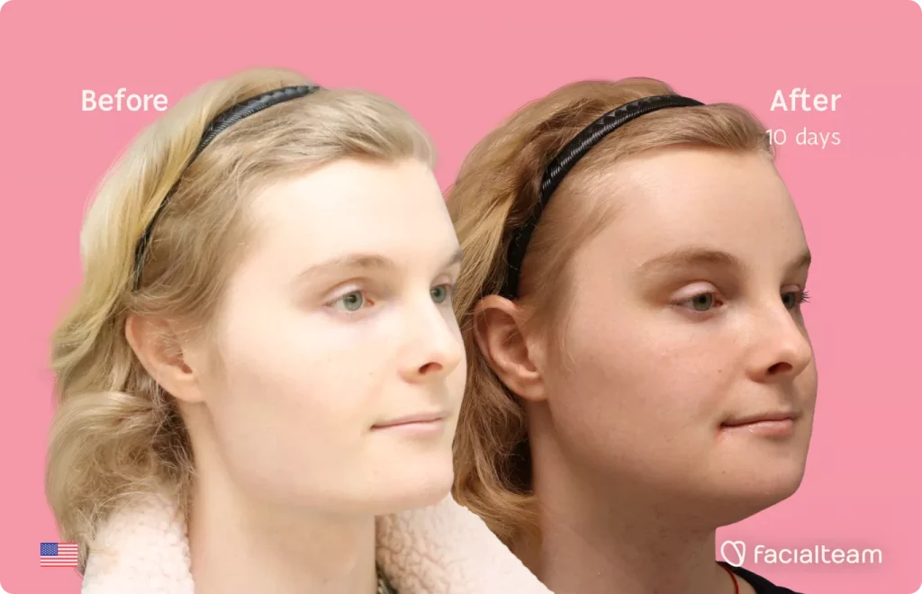 45 degree angle image of FFS patient Ashley showing the results before and after facial feminization surgery with Facialteam consisting of forehead feminization, tracheal shave, jaw and chin feminization.