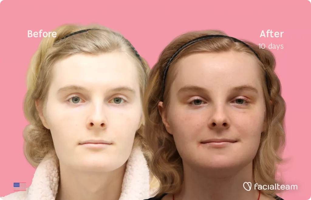 Frontal image of FFS patient Ashley showing the results before and after facial feminization surgery with Facialteam consisting of forehead feminization, tracheal shave, jaw and chin feminization.
