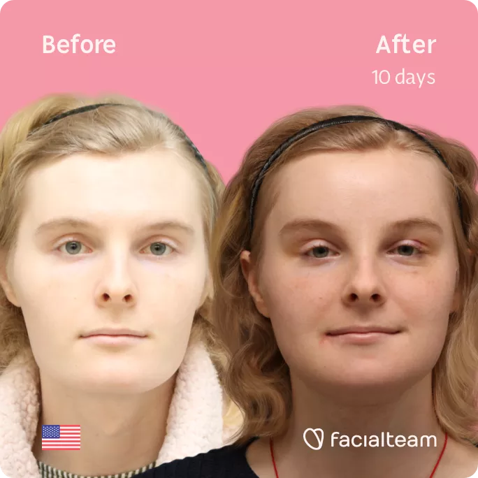 Square frontal image of FFS patient Ashley showing the results before and after facial feminization surgery with Facialteam consisting of forehead feminization, tracheal shave, jaw and chin feminization.