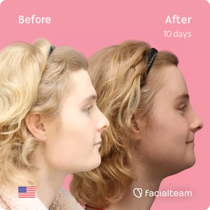 Square side image of FFS patient Ashley showing the results before and after facial feminization surgery with Facialteam consisting of forehead feminization, tracheal shave, jaw and chin feminization.