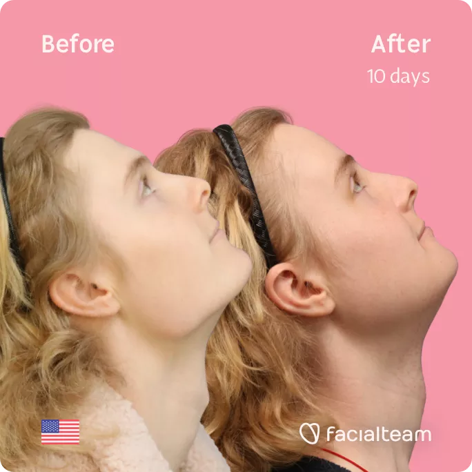 Square side up image of FFS patient Ashley showing the results before and after facial feminization surgery with Facialteam consisting of forehead feminization, tracheal shave, jaw and chin feminization.