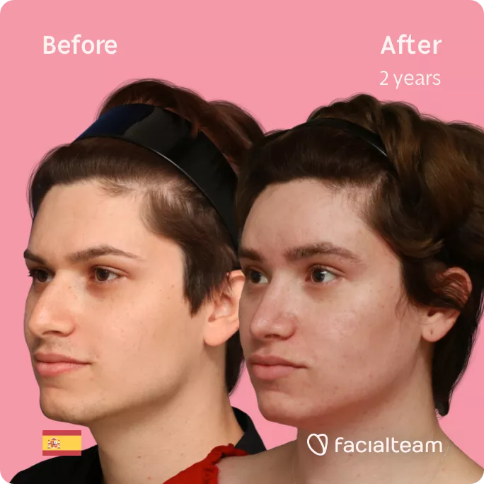 Square 45 degree left angle image of FFS patient Alicia showing the results before and after facial feminization surgery with Facialteam consisting of forehead feminization and rhinoplasty.