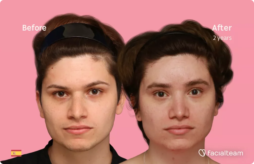 Frontal image of FFS patient Alicia showing the results before and after facial feminization surgery with Facialteam consisting of forehead feminization and rhinoplasty.