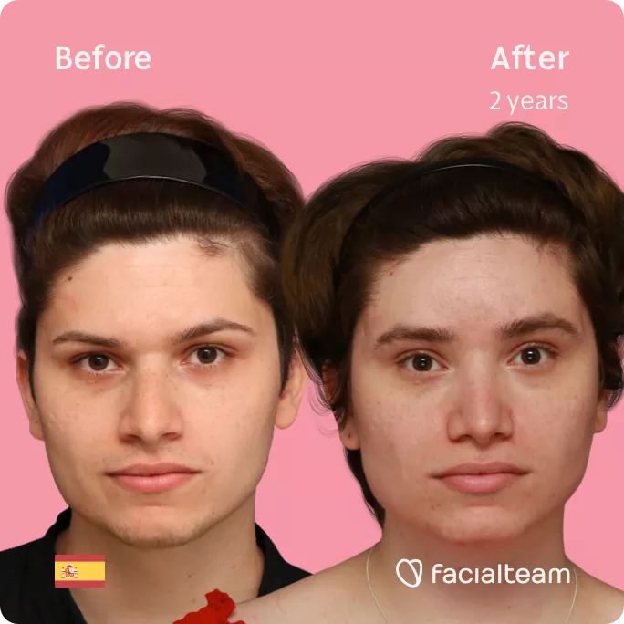 Square frontal image of FFS patient Alicia showing the results before and after facial feminization surgery with Facialteam consisting of forehead feminization and rhinoplasty.