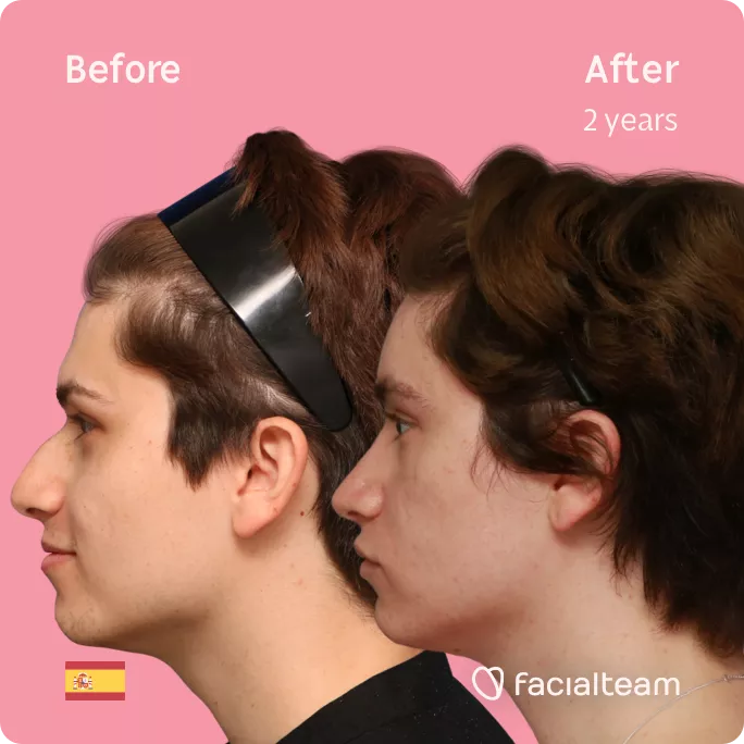 Square side image of FFS patient Alicia showing the results before and after facial feminization surgery with Facialteam consisting of forehead feminization and rhinoplasty.