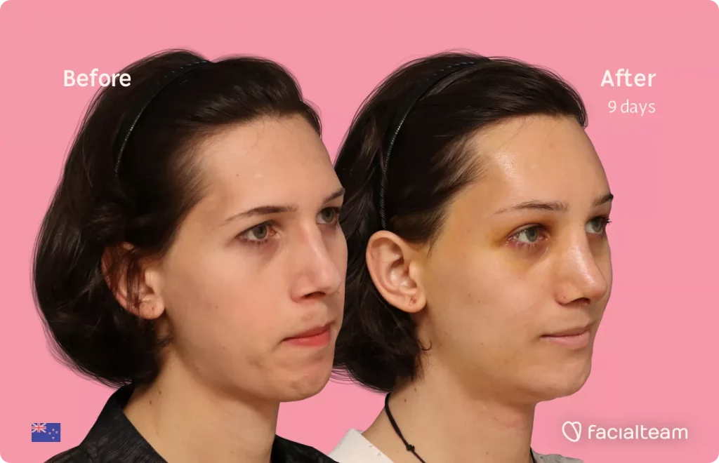 45 degree angle image of FFS patient Ellie showing the results before and after facial feminization surgery with Facialteam consisting of forehead feminization, rhinoplasty, tracheal shave and chin feminization.