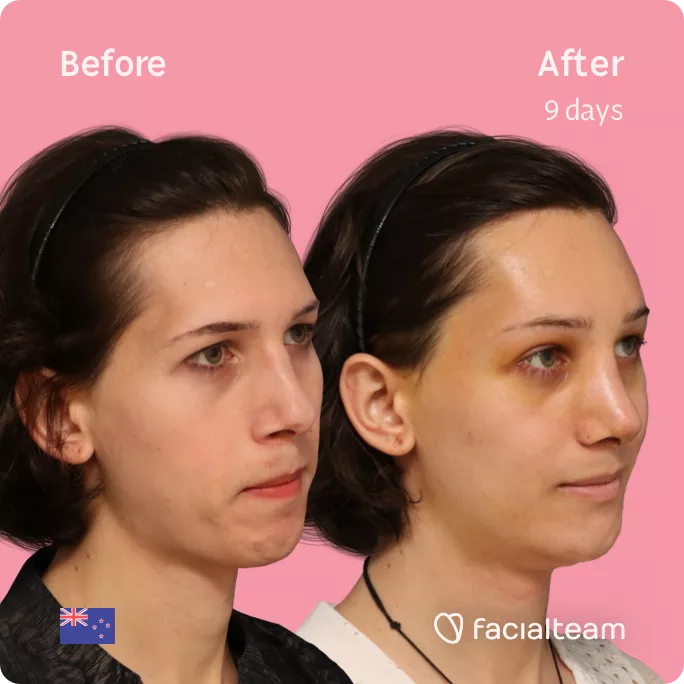 Square 45 degree angle image of FFS patient Ellie showing the results before and after facial feminization surgery with Facialteam consisting of forehead feminization, rhinoplasty, tracheal shave and chin feminization.