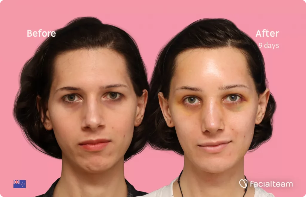 Frontal image of FFS patient Ellie showing the results before and after facial feminization surgery with Facialteam consisting of forehead feminization, rhinoplasty, tracheal shave and chin feminization.