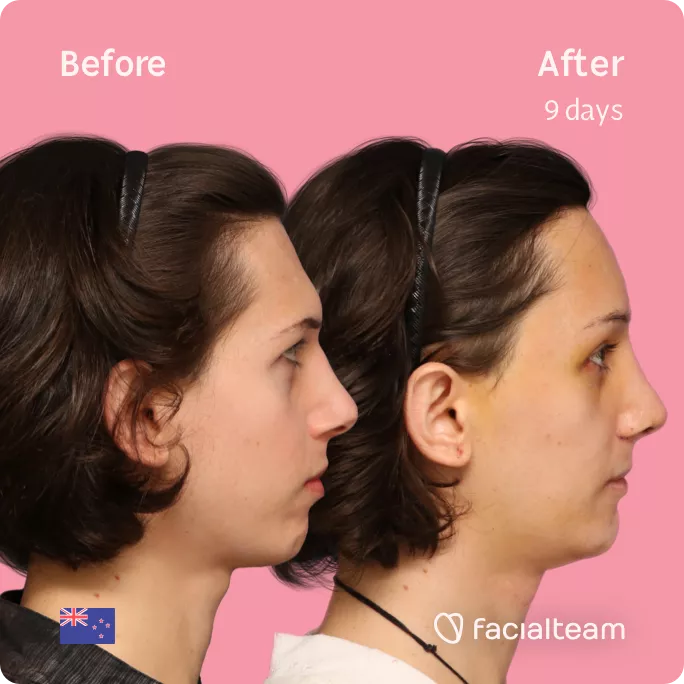 Square side image of FFS patient Ellie showing the results before and after facial feminization surgery with Facialteam consisting of forehead feminization, rhinoplasty, tracheal shave and chin feminization.