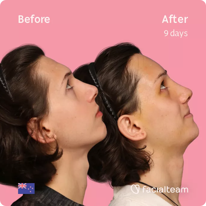 Square side up image of FFS patient Ellie showing the results before and after facial feminization surgery with Facialteam consisting of forehead feminization, rhinoplasty, tracheal shave and chin feminization.