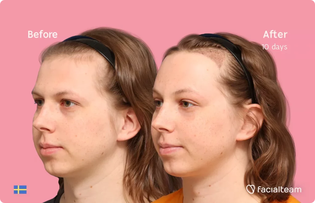 45 degree LEFT angle image of FFS patient Ellen showing the results before and after facial feminization surgery with Facialteam consisting of forehead feminization with SHT.