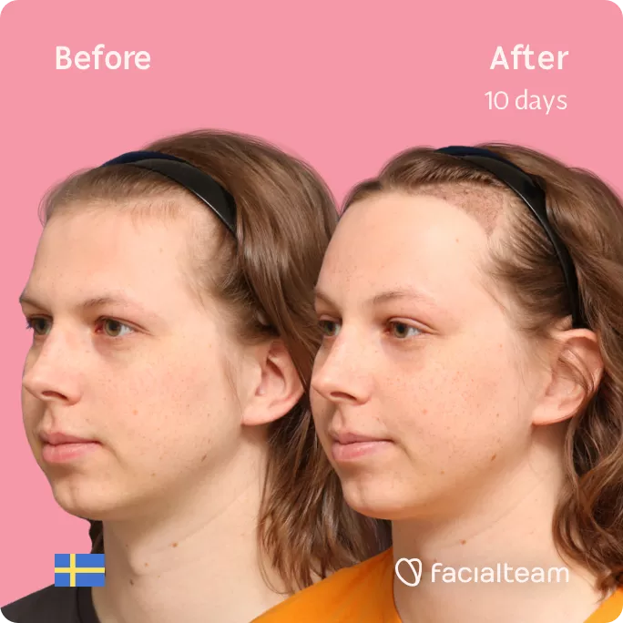 Square 45 degree LEFT angle image of FFS patient Ellen showing the results before and after facial feminization surgery with Facialteam consisting of forehead feminization with SHT.