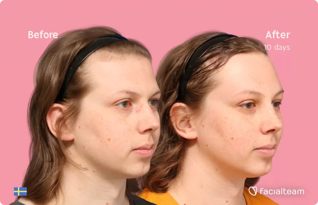 45 degree right angle image of FFS patient Ellen showing the results before and after facial feminization surgery with Facialteam consisting of forehead feminization with SHT.