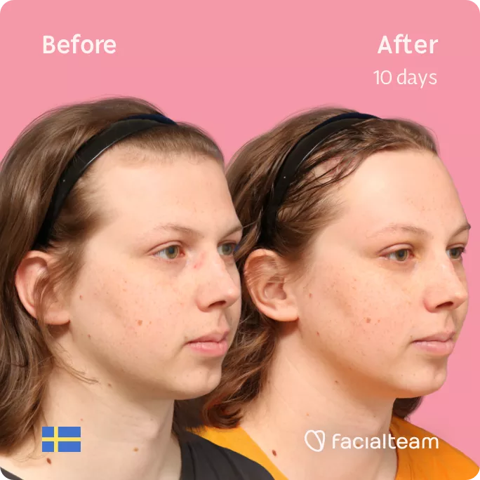 Square 45 degree right angle image of FFS patient Ellen showing the results before and after facial feminization surgery with Facialteam consisting of forehead feminization with SHT.