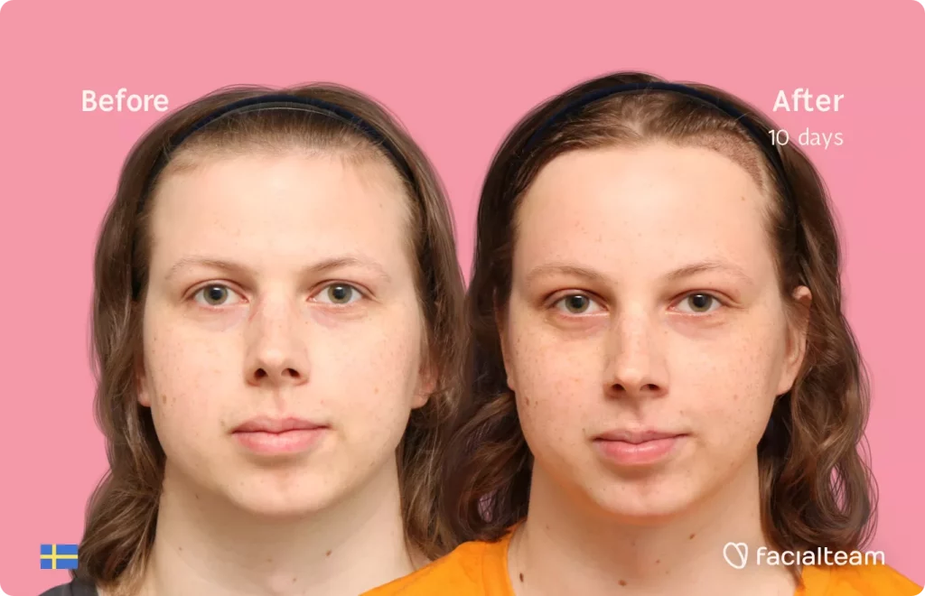 Frontal image of FFS patient Ellen showing the results before and after facial feminization surgery with Facialteam consisting of forehead feminization with SHT.
