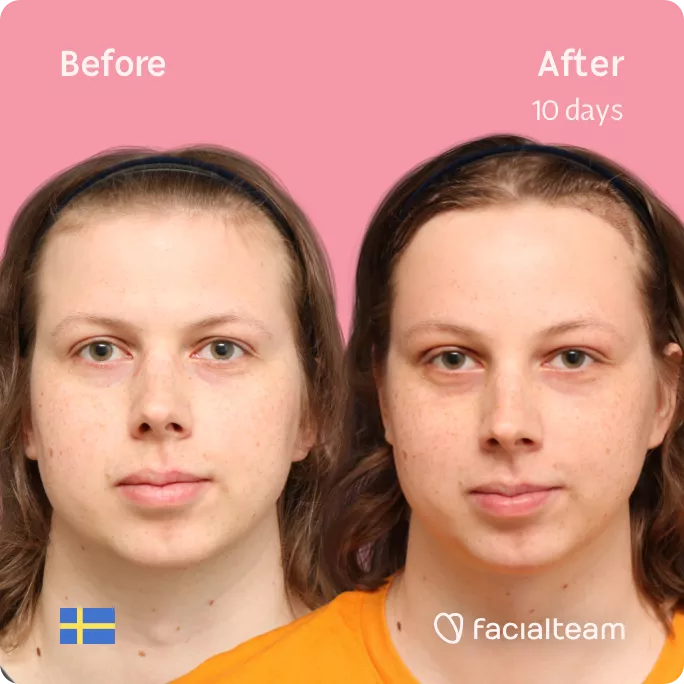 Square frontal image of FFS patient Ellen showing the results before and after facial feminization surgery with Facialteam consisting of forehead feminization with SHT.