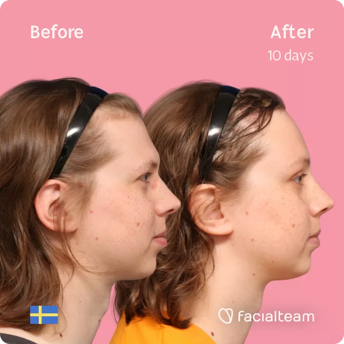 Square side image of FFS patient Ellen showing the results before and after facial feminization surgery with Facialteam consisting of forehead feminization with SHT.