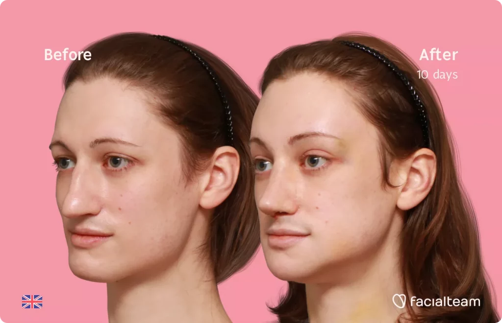 45 degree left angle image of FFS patient Lydia showing the results before and after facial feminization surgery with Facialteam consisting of forehead, rhinoplasty, jaw and chin feminization.