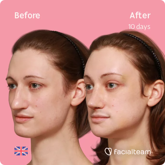 Square 45 degree left angle image of FFS patient Lydia showing the results before and after facial feminization surgery with Facialteam consisting of forehead, rhinoplasty, jaw and chin feminization.