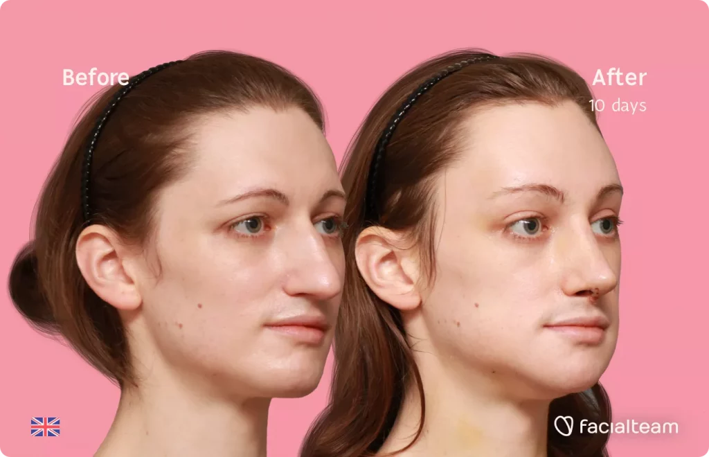 45 degree right angle image of FFS patient Lydia showing the results before and after facial feminization surgery with Facialteam consisting of forehead, rhinoplasty, jaw and chin feminization.