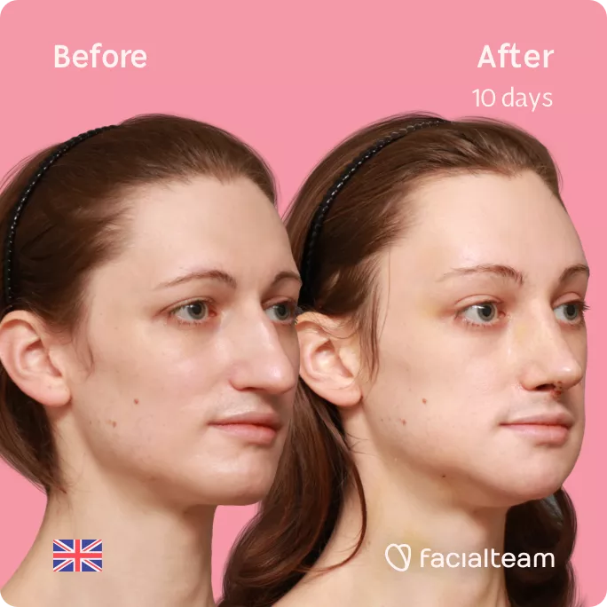 Square 45 degree right angle image of FFS patient Lydia showing the results before and after facial feminization surgery with Facialteam consisting of forehead, rhinoplasty, jaw and chin feminization.