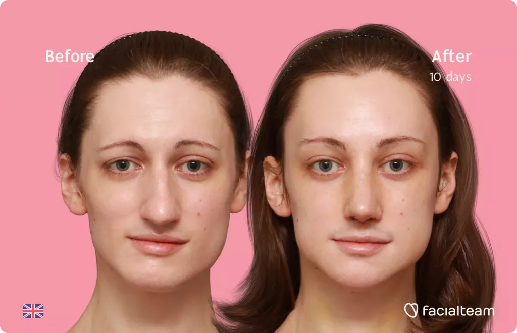 Frontal image of FFS patient Lydia showing the results before and after facial feminization surgery with Facialteam consisting of forehead, rhinoplasty, jaw and chin feminization.