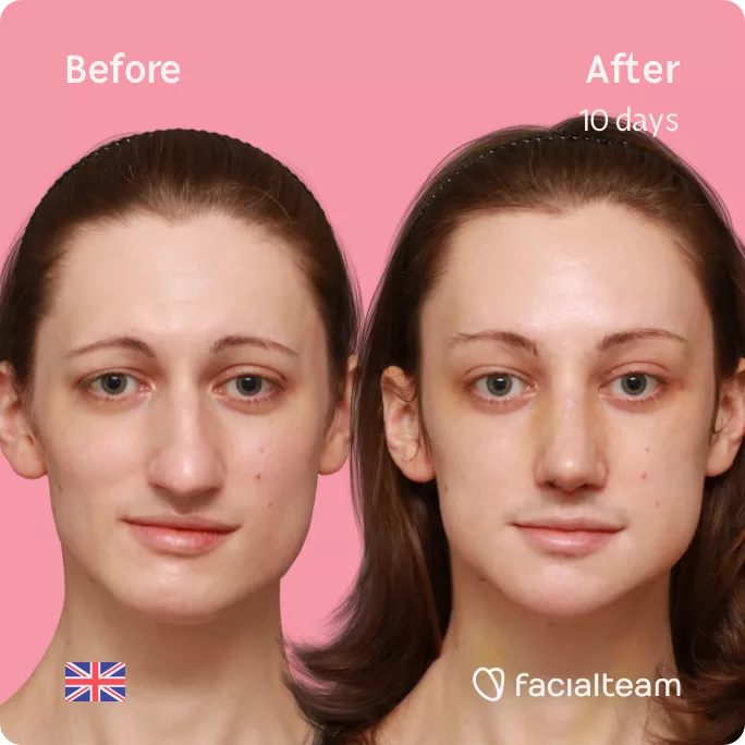 Square frontal image of FFS patient Lydia showing the results before and after facial feminization surgery with Facialteam consisting of forehead, rhinoplasty, jaw and chin feminization.