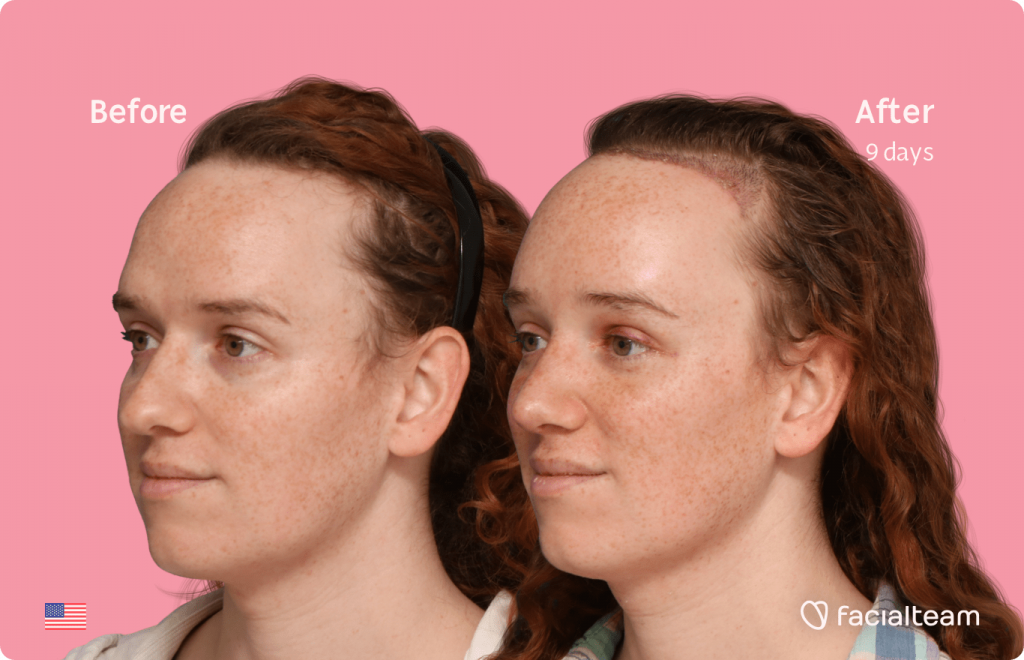 45 degree left angle image of FFS patient Tiffany showing the results before and after facial feminization surgery with Facialteam consisting of forehead with SHT, rhinoplasty, tracheal shave, jaw and chin feminization.