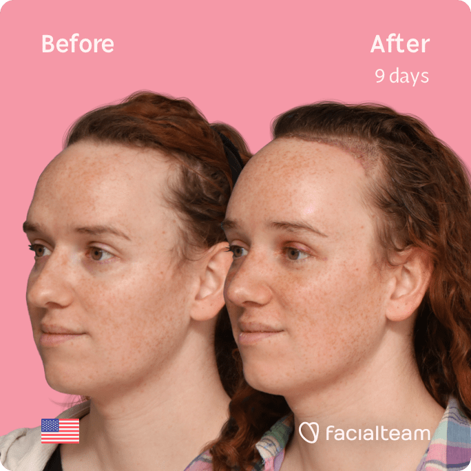 Square 45 degree left angle image of FFS patient Tiffany showing the results before and after facial feminization surgery with Facialteam consisting of forehead with SHT, rhinoplasty, tracheal shave, jaw and chin feminization.
