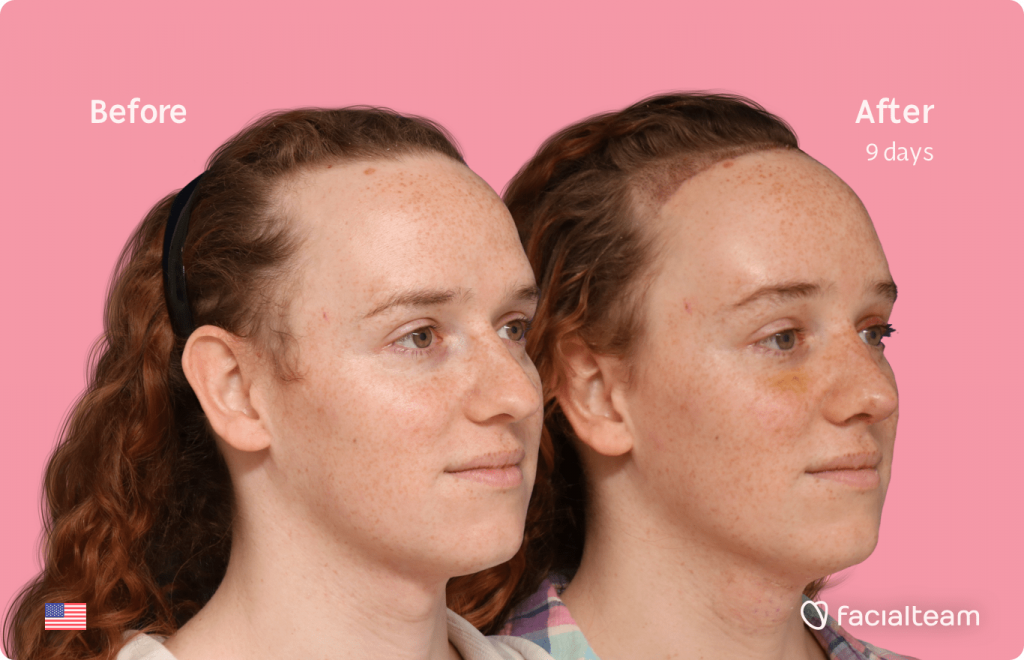 45 degree right angle image of FFS patient Tiffany showing the results before and after facial feminization surgery with Facialteam consisting of forehead with SHT, rhinoplasty, tracheal shave, jaw and chin feminization.