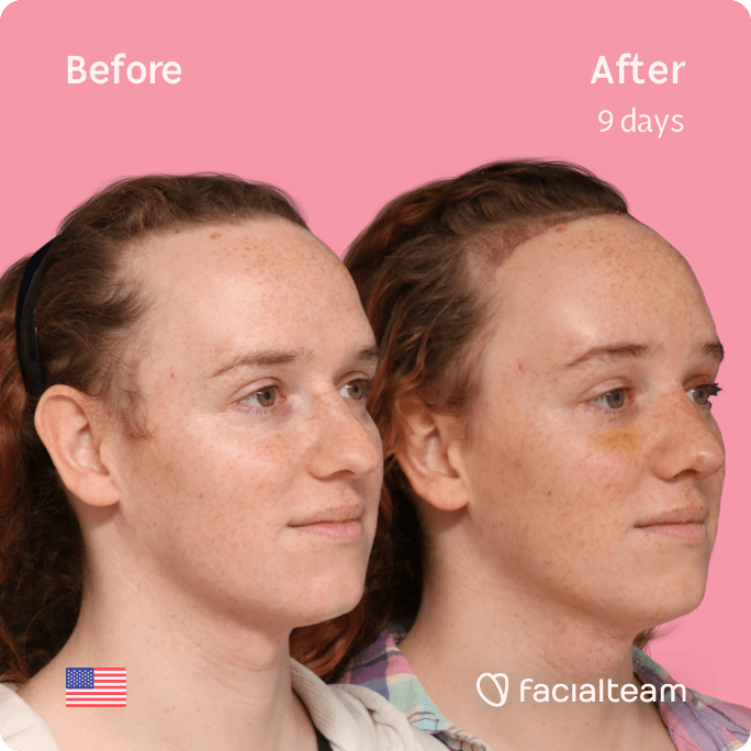 Square 45 degree right angle image of FFS patient Tiffany showing the results before and after facial feminization surgery with Facialteam consisting of forehead with SHT, rhinoplasty, tracheal shave, jaw and chin feminization.