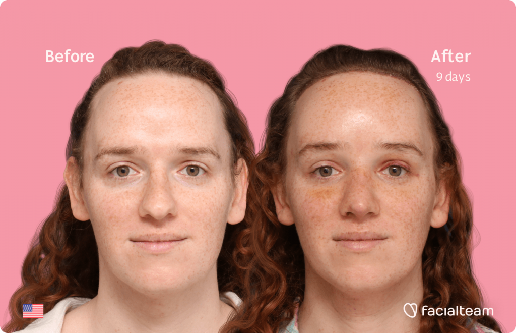 Frontal image of FFS patient Tiffany showing the results before and after facial feminization surgery with Facialteam consisting of forehead with SHT, rhinoplasty, tracheal shave, jaw and chin feminization.