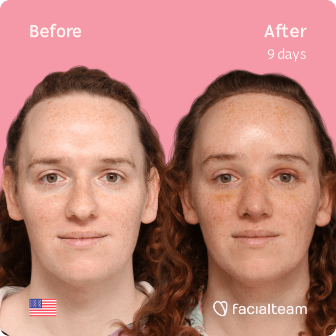Square frontal image of FFS patient Tiffany showing the results before and after facial feminization surgery with Facialteam consisting of forehead with SHT, rhinoplasty, tracheal shave, jaw and chin feminization.