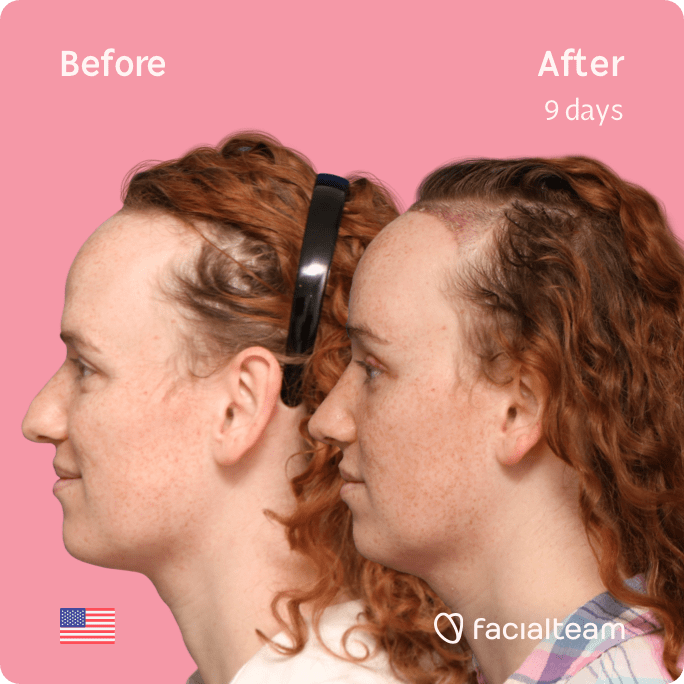 Square side image of FFS patient Tiffany showing the results before and after facial feminization surgery with Facialteam consisting of forehead with SHT, rhinoplasty, tracheal shave, jaw and chin feminization.