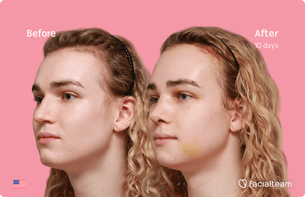 45 degree left angle image of FFS patient Keira showing the results before and after facial feminization surgery with Facialteam consisting of forehead with SHT, rhinoplasty, jaw and chin feminization.