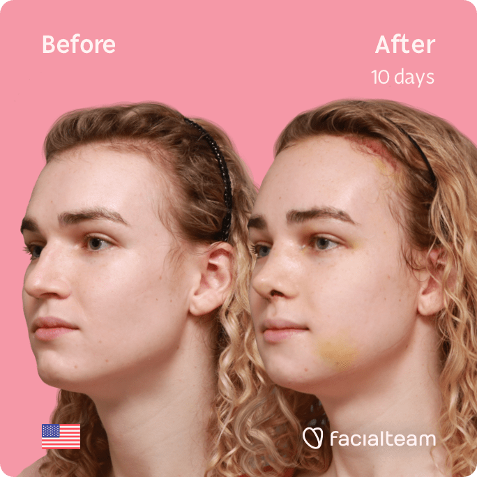 Square 45 degree left angle image of FFS patient Keira showing the results before and after facial feminization surgery with Facialteam consisting of forehead with SHT, rhinoplasty, jaw and chin feminization.