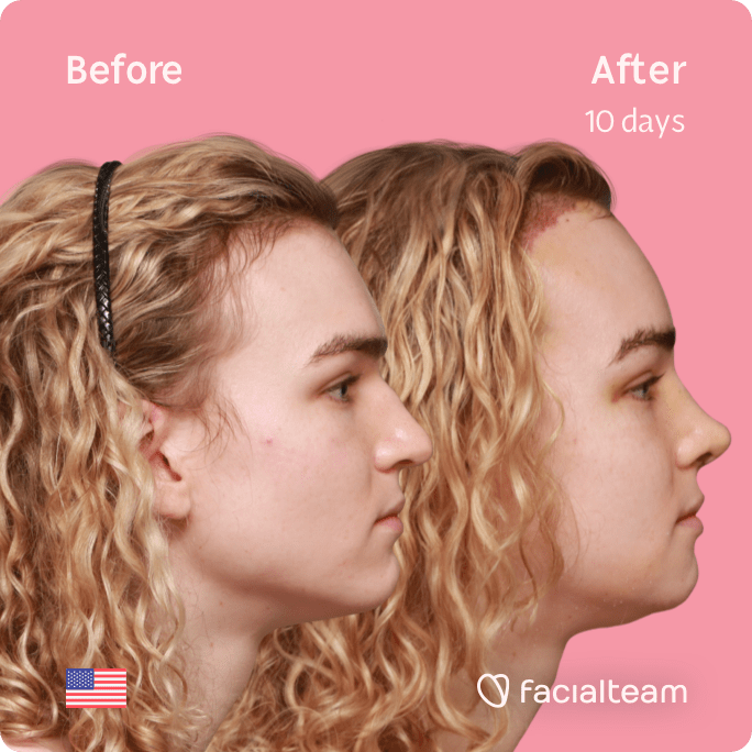 Square side image of FFS patient Keira showing the results before and after facial feminization surgery with Facialteam consisting of forehead with SHT, rhinoplasty, jaw and chin feminization.