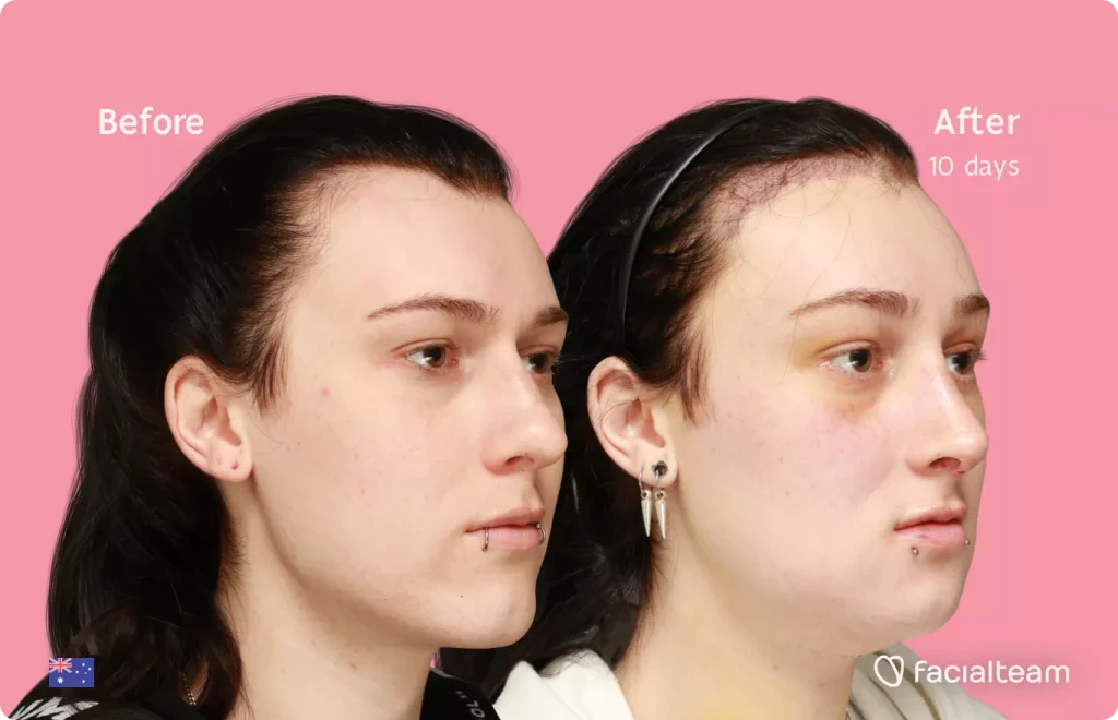 45 degree angle image of FFS patient Evelyn showing the results before and after facial feminization surgery with Facialteam consisting of forehead with SHT, rhinoplasty, tracheal shave, jaw and chin feminization.