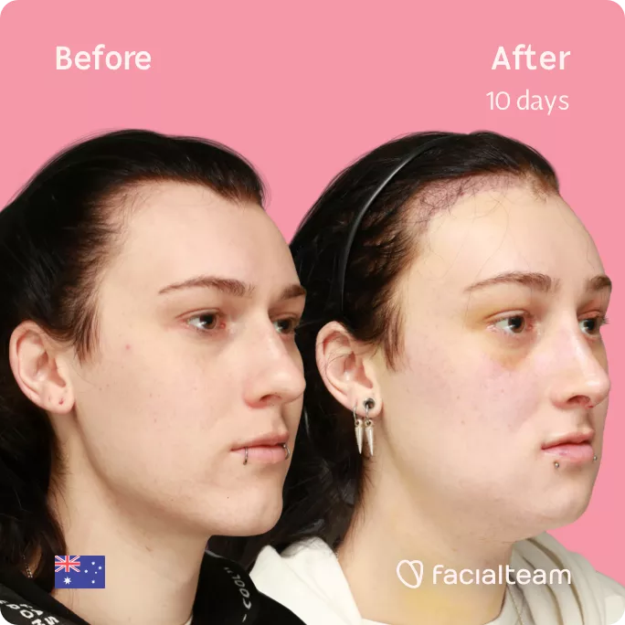 Square 45 degree angle image of FFS patient Evelyn showing the results before and after facial feminization surgery with Facialteam consisting of forehead with SHT, rhinoplasty, tracheal shave, jaw and chin feminization.