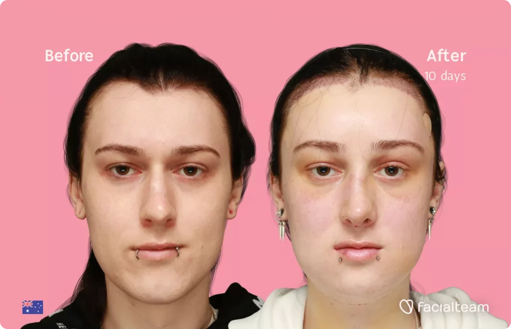 Frontal image of FFS patient Evelyn showing the results before and after facial feminization surgery with Facialteam consisting of forehead with SHT, rhinoplasty, tracheal shave, jaw and chin feminization.
