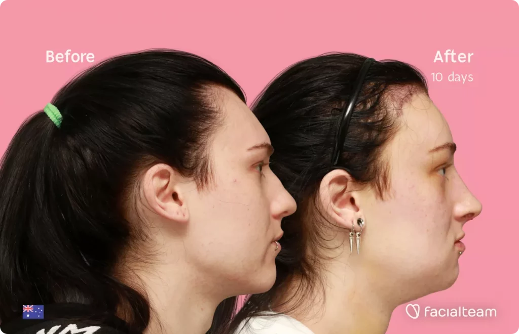 Side image of FFS patient Evelyn showing the results before and after facial feminization surgery with Facialteam consisting of forehead with SHT, rhinoplasty, tracheal shave, jaw and chin feminization.