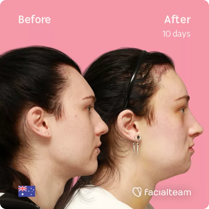 Square side image of FFS patient Evelyn showing the results before and after facial feminization surgery with Facialteam consisting of forehead with SHT, rhinoplasty, tracheal shave, jaw and chin feminization.