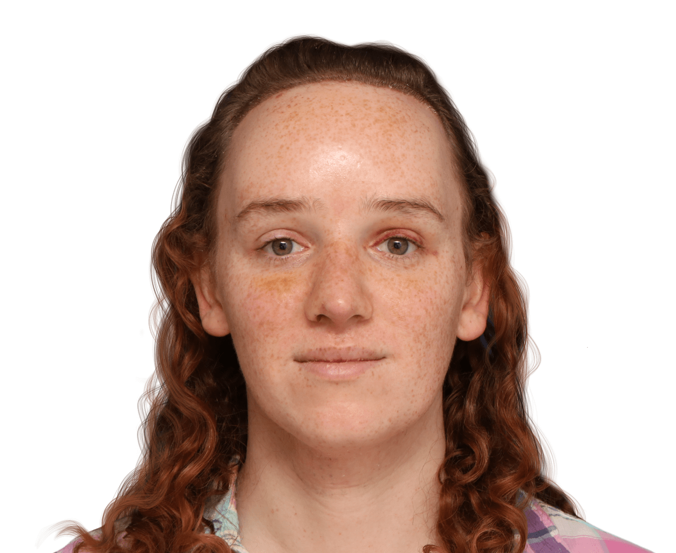 Tiffany Before and After FFS Surgery — Facialteam