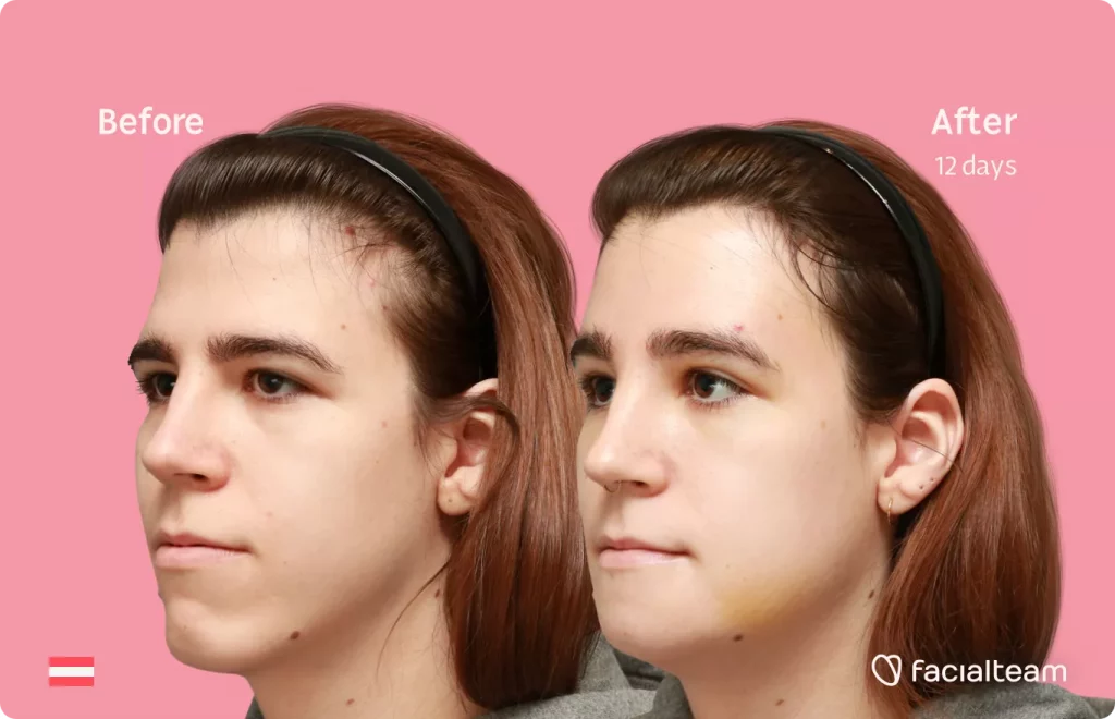 45 degree left angle image of FFS patient Emma H showing the results before and after facial feminization surgery with Facialteam consisting of forehead and chin feminization.
