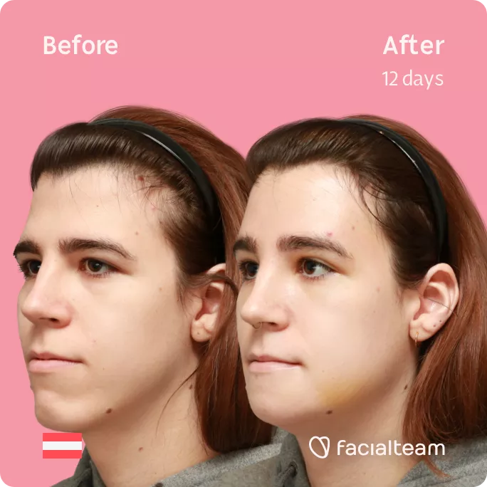 Square 45 degree left angle image of FFS patient Emma H showing the results before and after facial feminization surgery with Facialteam consisting of forehead and chin feminization.