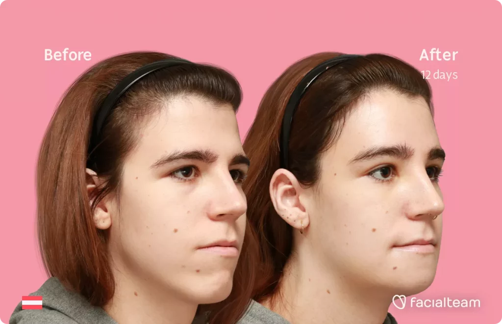 45 degree right angle image of FFS patient Emma H showing the results before and after facial feminization surgery with Facialteam consisting of forehead and chin feminization.