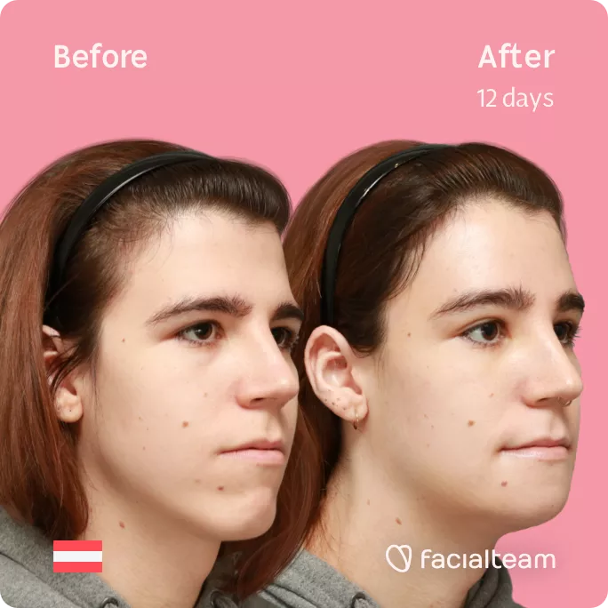Square 45 degree right angle image of FFS patient Emma H showing the results before and after facial feminization surgery with Facialteam consisting of forehead and chin feminization.