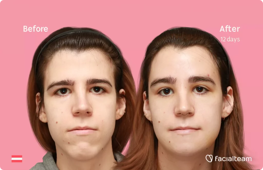 Frontal image of FFS patient Emma H showing the results before and after facial feminization surgery with Facialteam consisting of forehead and chin feminization.