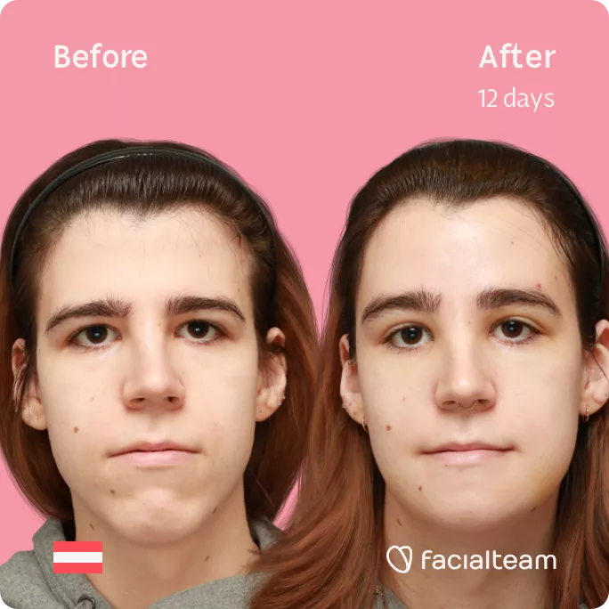 Square frontal image of FFS patient Emma H showing the results before and after facial feminization surgery with Facialteam consisting of forehead and chin feminization.